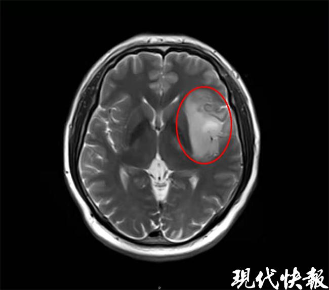 脑寄生虫患者的脑部核磁共振影像