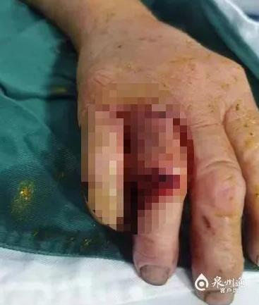 福建泉州女子被蛇咬到的右手无名指