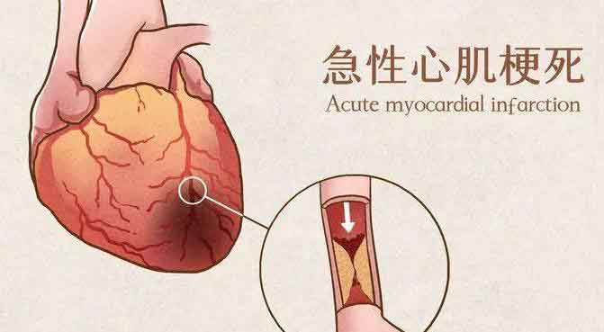 急性心肌梗死