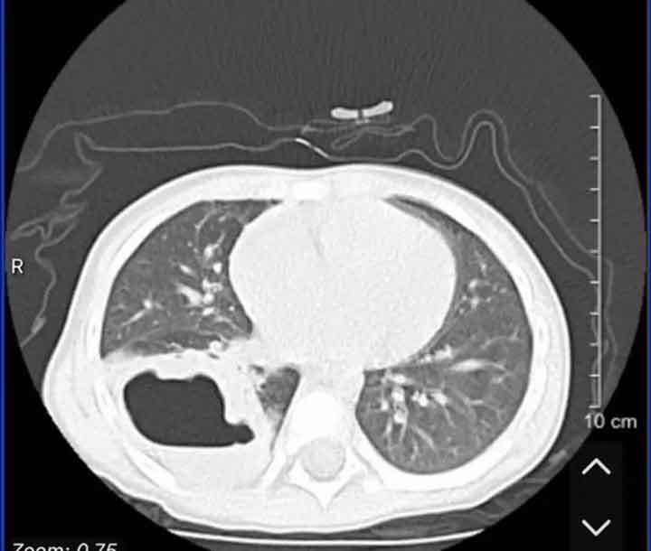 病初肺部CT查出“肺空洞”