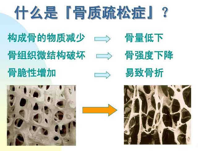 骨质疏松症说明